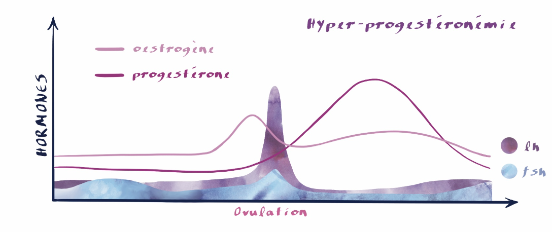 Hyper-progestéronémie, déséquilibre hormonale, cycle menstruel, syndrome prémenstruel